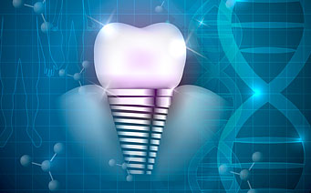 Dantų implantų ženklo svarba