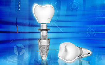 Kas yra dantų implantai?